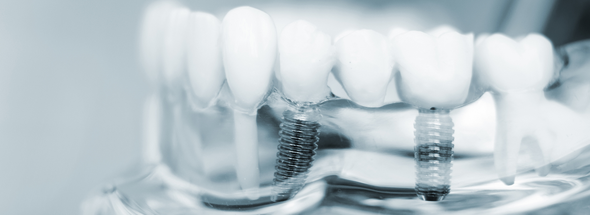 The image shows a close-up of a row of white teeth with small screws visible between them, against a blurred background.