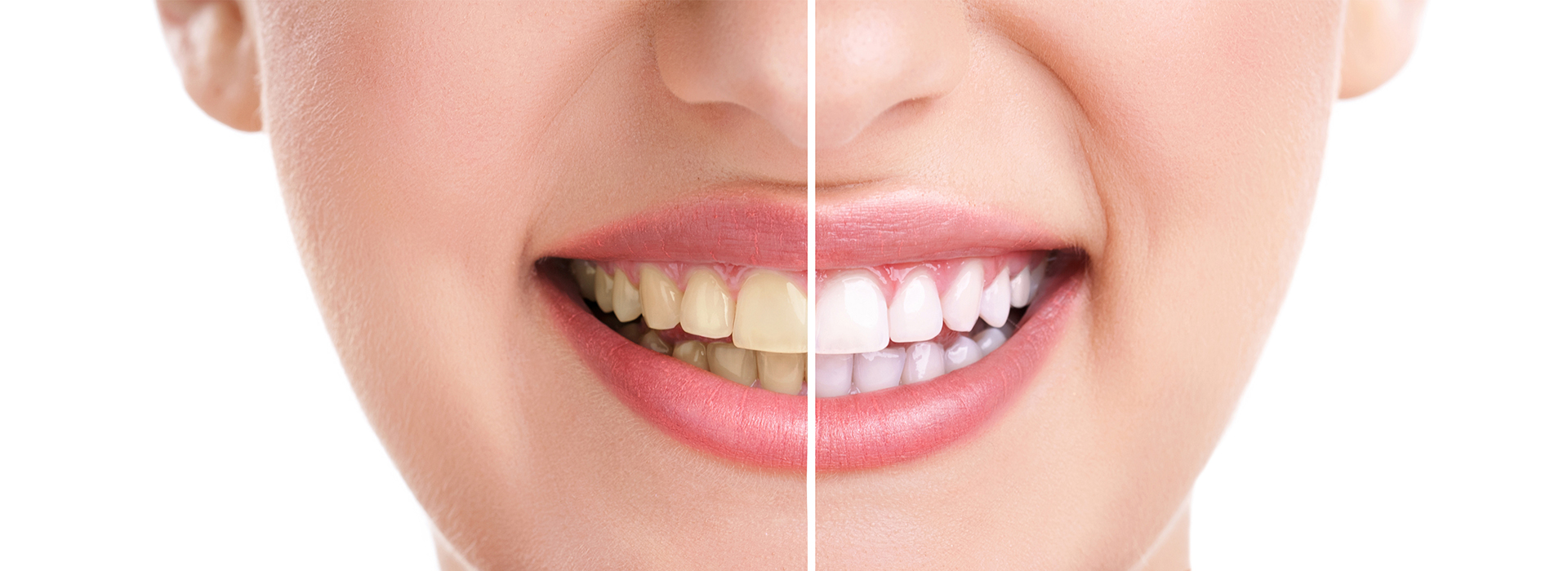 The image shows a close-up of a person s face with a bright smile, displaying white teeth.